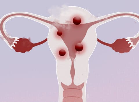 Diagnóstico y tratamiento de los miomas uterinos