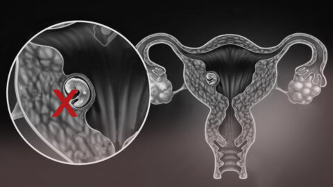 ¿Qué es un Embarazo o aborto Bioquímico?