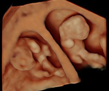 Más de la mitad de las transferencias de óvulos donados son de un único embrión para evitar los embarazos múltiples en el Instituto Bernabeu