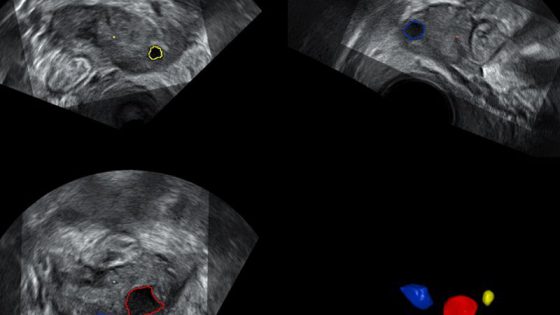 Fortschritte bei der Diagnose der niedrigen ovariellen Reserve in Verbindung mit dem Interleukin-10-Spiegel
