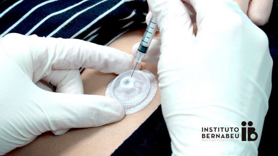 Das Instituto Bernabeu reduziert die Zahl der Spritzen für die ovarielle Stimulation