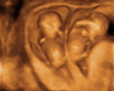 Die Häufigkeit von Zwillingsschwangerschaften steigt nach der Embryonenbiopsie, laut einer Studie des Instituto Bernabeu, die in der Fachzeitschrift JBRA veröffentlicht wurde