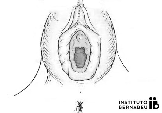 buscar Acuario novela Hipertrofia genital o de ninfas: Cirugía de labios vaginales