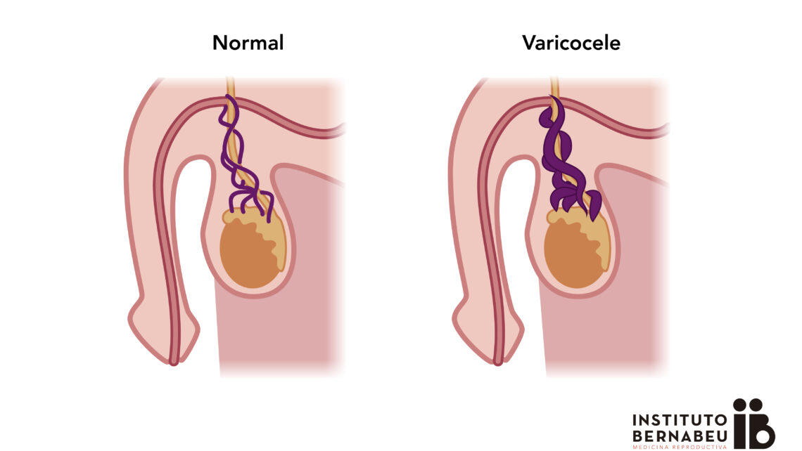 Varicocele Diagnosis & Treatment