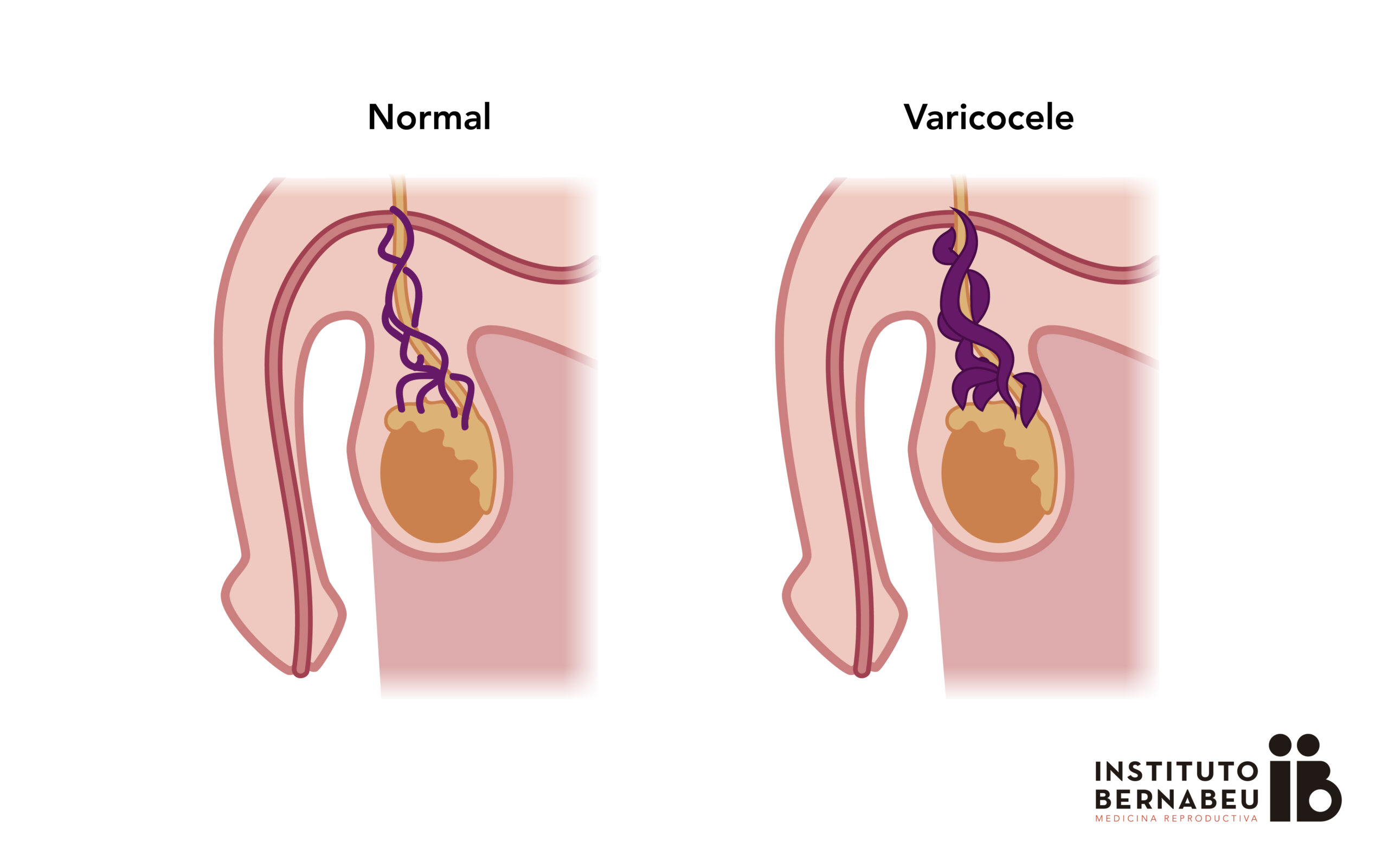 Varicocele Infertility Causes, Symptoms, Treatment & Surgery