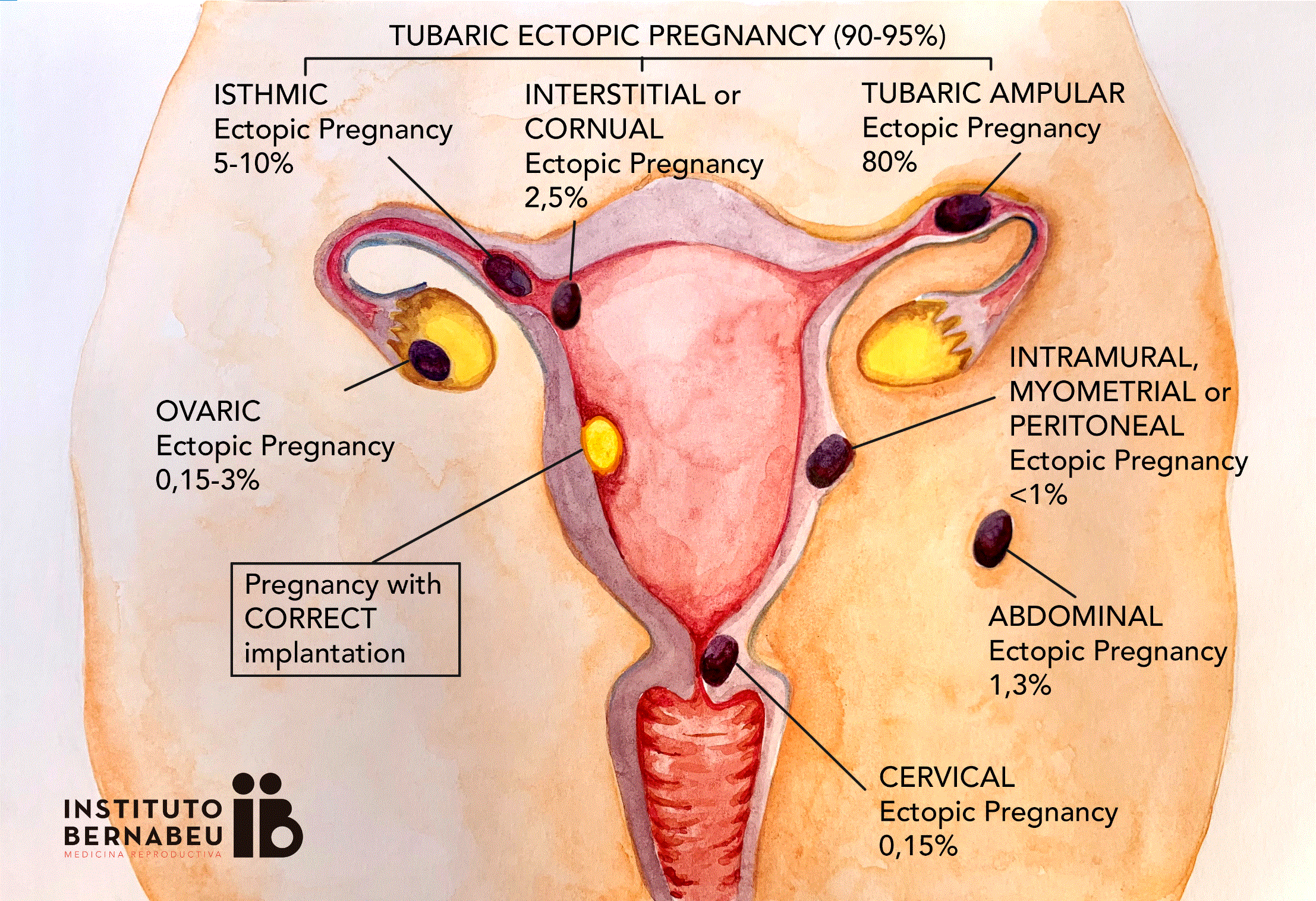 Ectopic Pregnancy