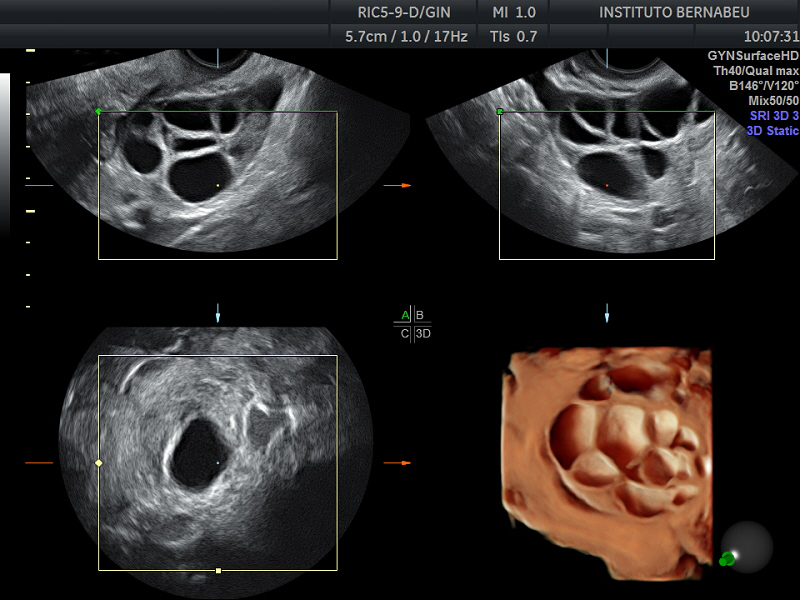 Is Ovary Size Important