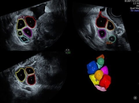 Das Instituto Bernabeu erläutert in der wissenschaftlichen Zeitschrift Fertility and Sterility die Epigenetik des Eierstocks bei Frauen mit niedriger ovarieller Reserve