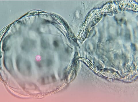 Pregnancy outcomes improve after “artificially collapsing” the embryo before freezing. A new study presented at ESHRE 2021